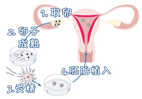三代试管代怀包生捐卵公司